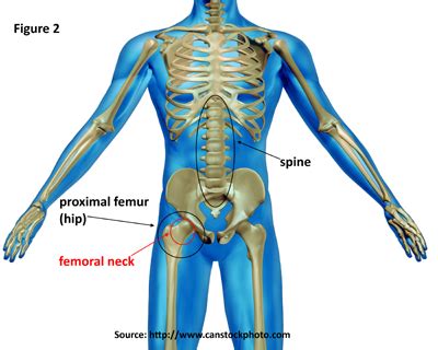 icd 10 fracture of femur|closed left hip fracture icd 10.